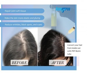 Biotin PRP  for Healthy Hair Growth
