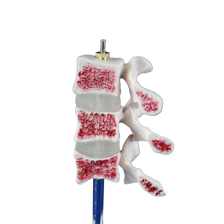 High Quality Life-Size Cutaway Osteoporosis skeleton Model