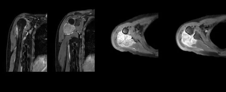 Juhtumiuuringute jagamine |3D-prinditud osteotoomia juhend ja isikupärastatud proteesid tagurpidi õla asendusoperatsiooni jaoks 