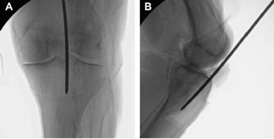 Selection of the entry point for Intramedullary of Tibial Fractures