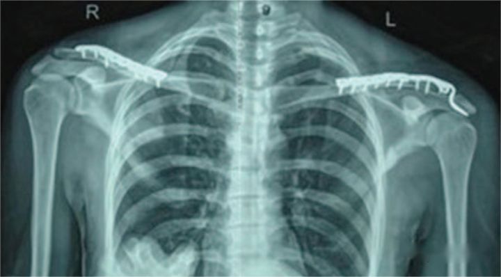How to stabilize a midshaft clavicle fracture combined with ipsilateral acromioclavicular dislocation?