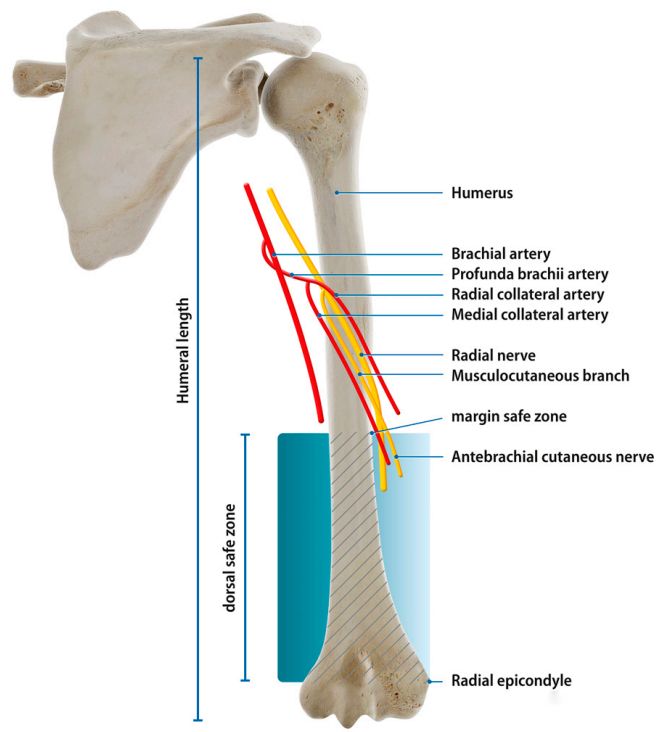 Humerusa posterior yaklaşımda “radyal sinirin” yerini tespit etmek için bir yöntemin tanıtılması