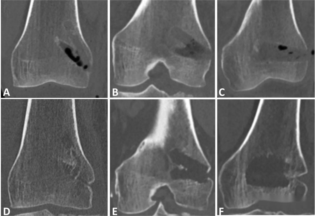 Technique chirurgicale |Fixation interne de greffe de condyle fémoral homolatéral pour le traitement des fractures du plateau tibial