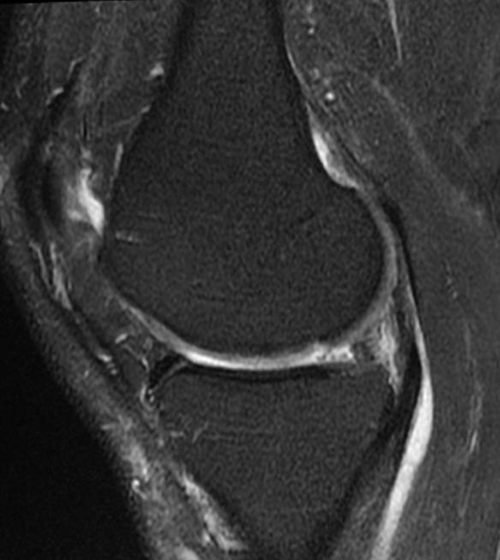 تشخيص التصوير بالرنين المغناطيسي لتمزق الغضروف المفصلي لمفصل الركبة