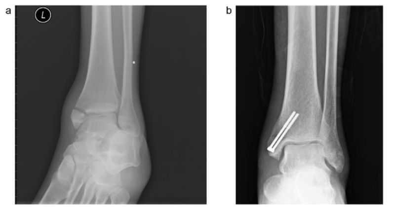 Surgical Technique: Headless Compression Screws Effectively Treat Internal Ankle Fractures