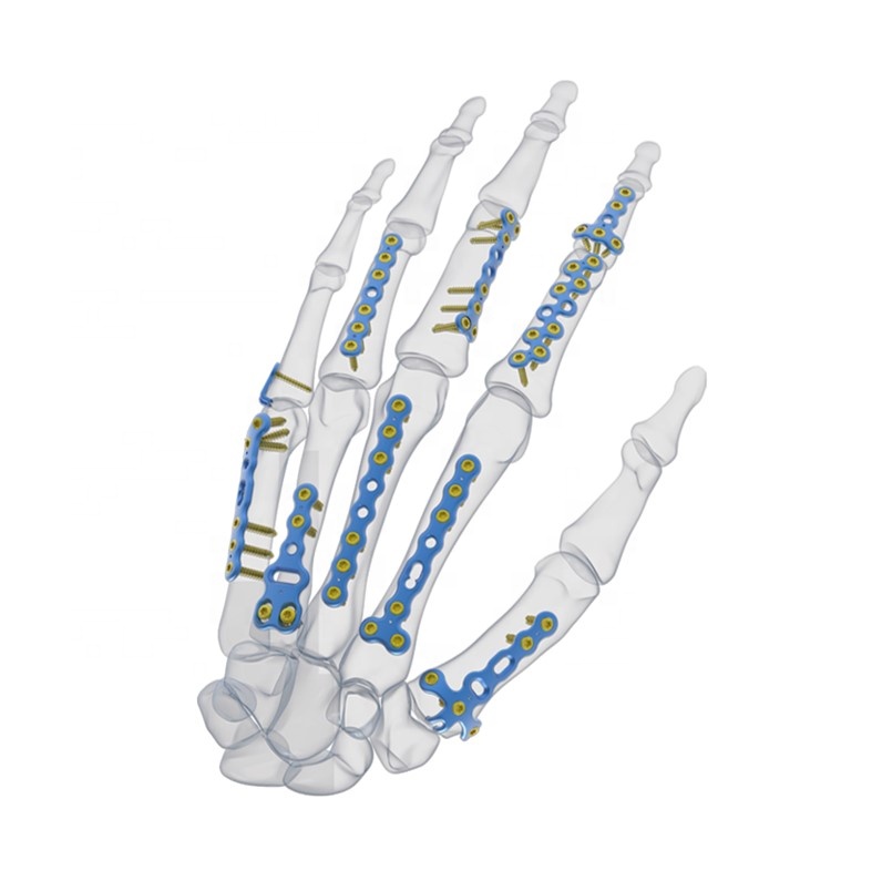 High Quality Orthopedic Trauma Implants – T-Phalange Locking Plates Type II – Chenanhui