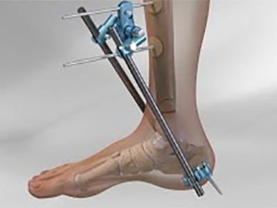 Teknolojia Orthopedic: Fixation ivelany ny fractures