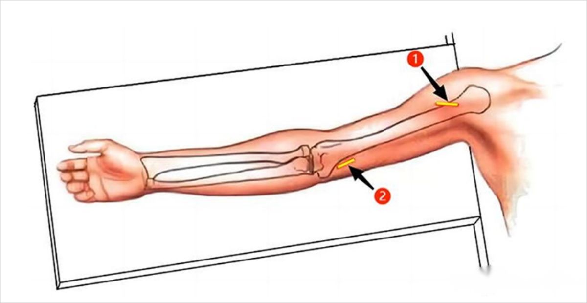 «Внутренняя фиксация переломов диафиза плечевой кости с использованием техники медиального внутреннего пластинчатого остеосинтеза (MIPPO)».