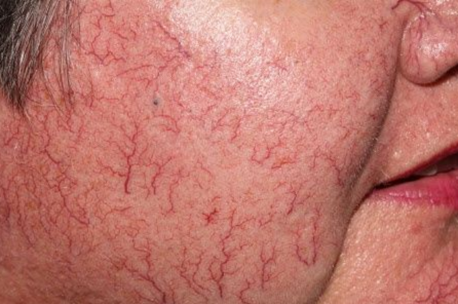 What is Telangiectasia (red blood)?