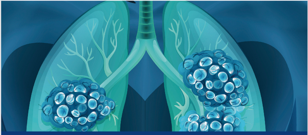 با آزمایش پیشرفته جهش EGFR، درمان دقیق NSCLC را ممکن کنید