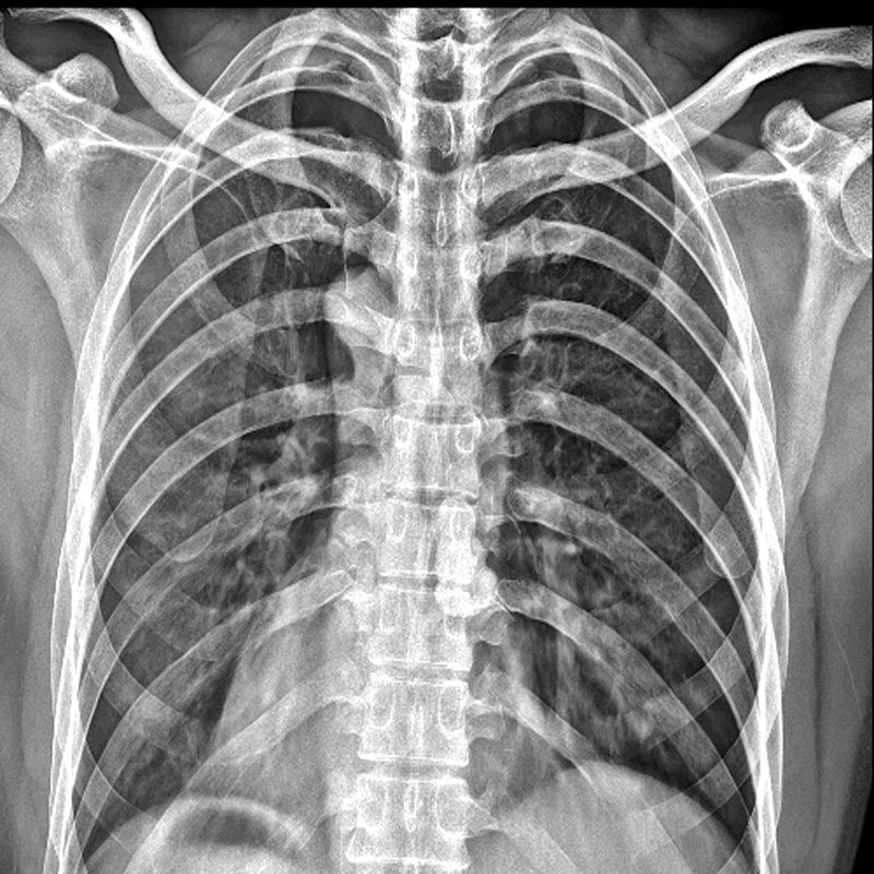 Pectore X-ray vs. Pectore CT: Intellectus differentiae