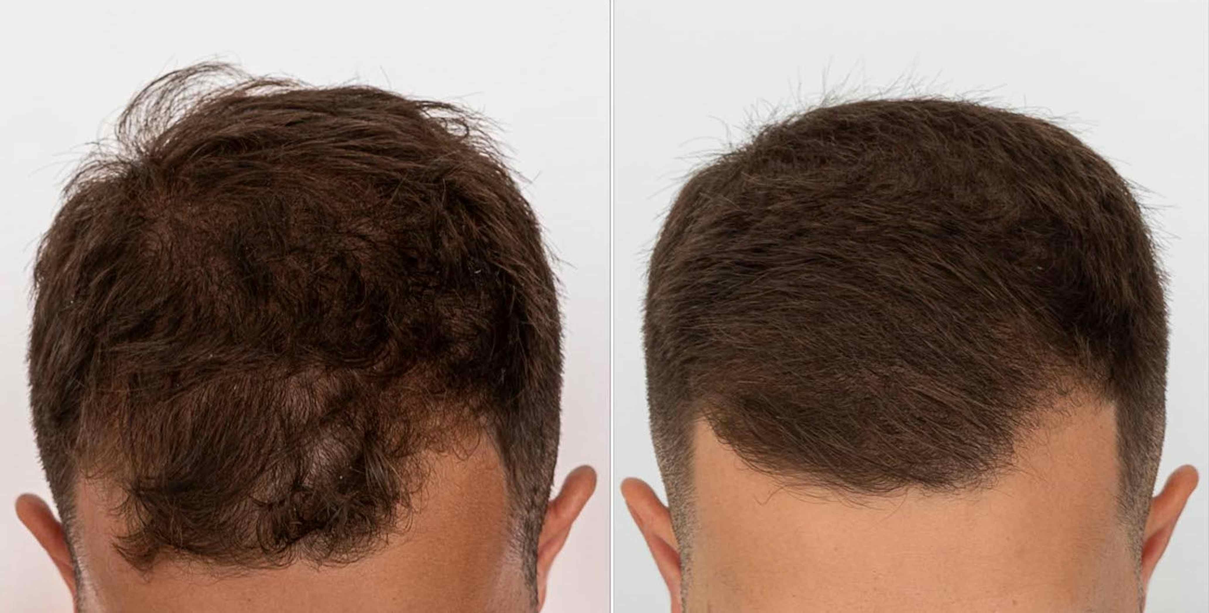 Minoxidil: Application Of The “Magic Hair Growt...