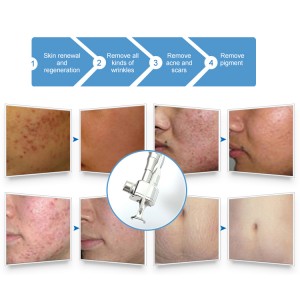 High Effective Co2 Fractional Laser Machine For Skin Renewing And Resurfacing