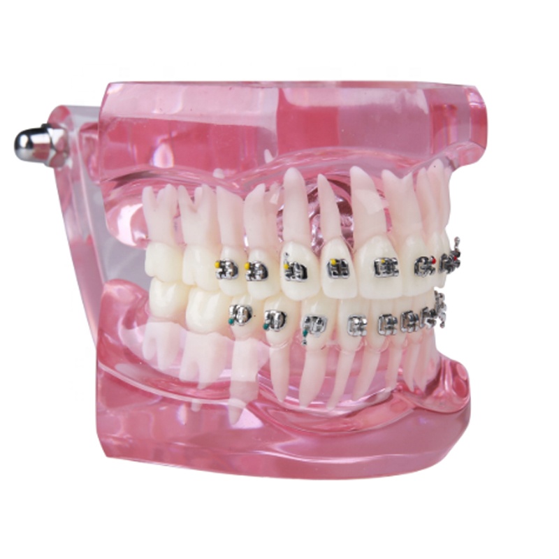 Trending Products Dental Periodontal Probe - dental teeth study model M3001 dental orthodontics model with full metal brackets – Onice