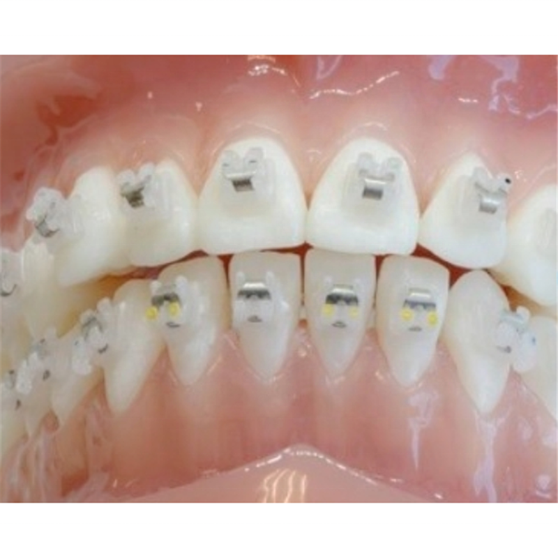 New Arrival China 330 Dental Bur - MBT ceramic self ligating bracket brace high-quality dental orthodontic bracketb dental consumablel ceramic bracket – Onice