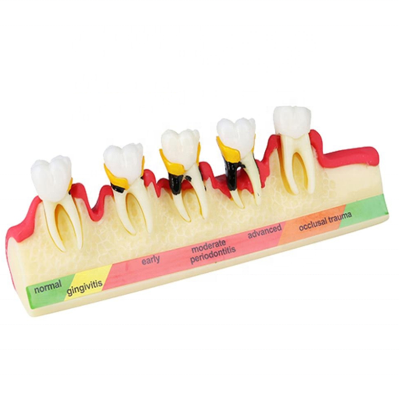 Professional China Digital Dental Xray Sensor - dental pathological periodontal disease model orthodontic medical instrument dental teaching teeth model – Onice