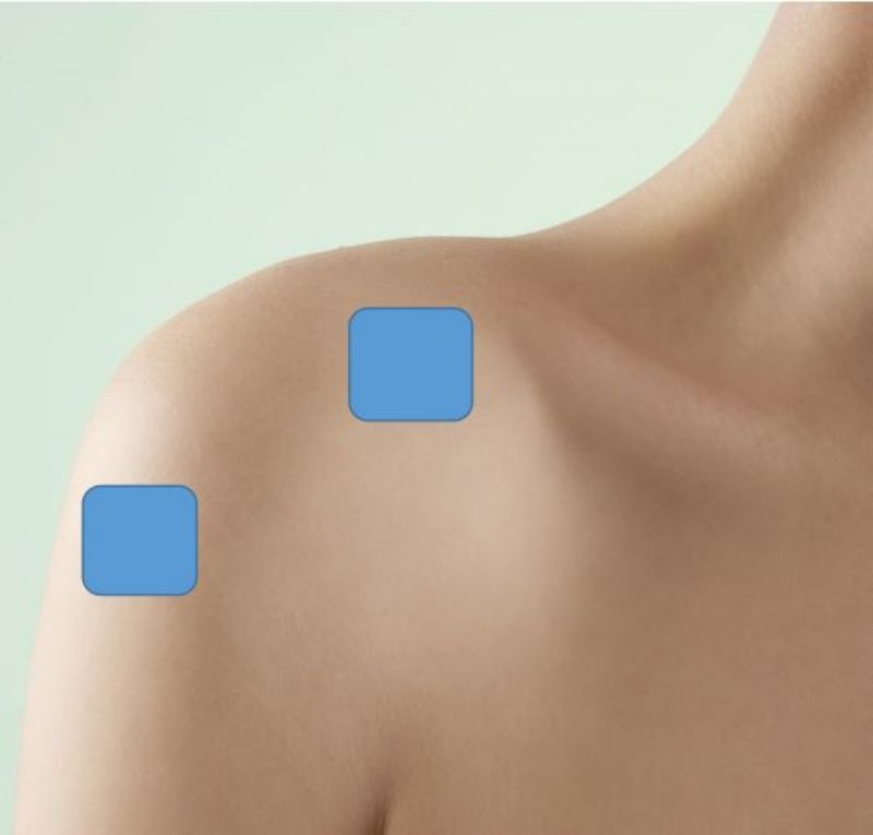 Periarthritis of shoulder
