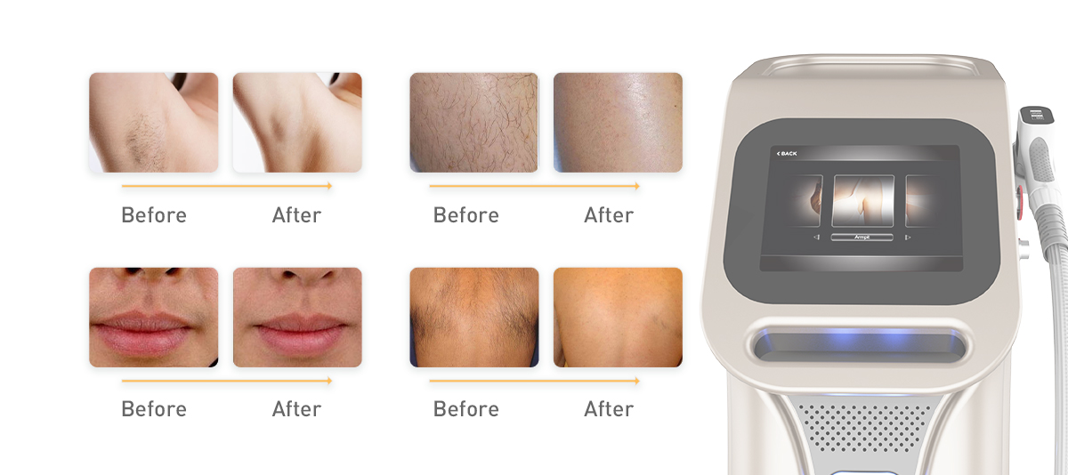 Long-term Maintenance of 808 Diode Laser Hair Removal Machines