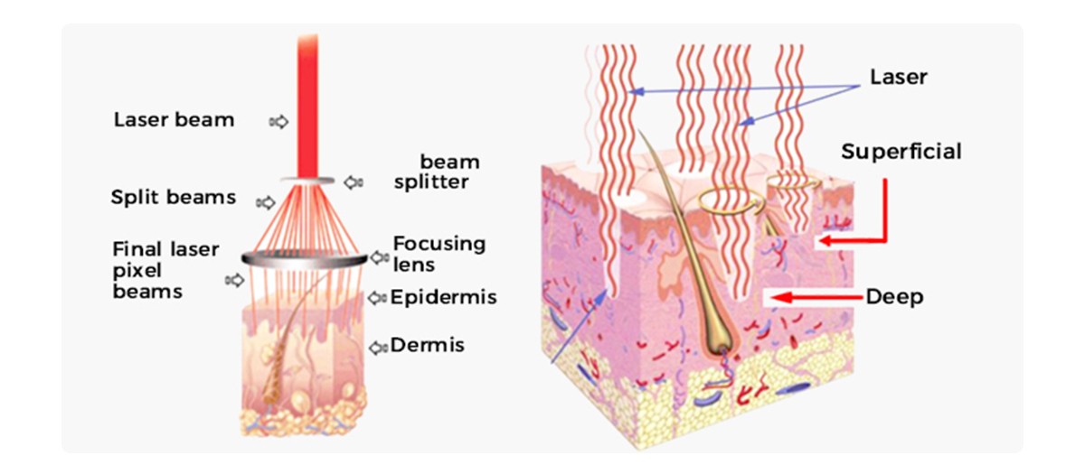 Unlocking the Power of Medical Fractional CO2 Laser Machine: Revolutionizing Skin Resurfacing and Gynecology Treatments