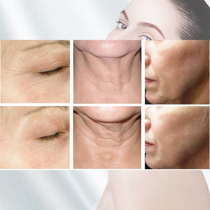Hifu for face and body lifting