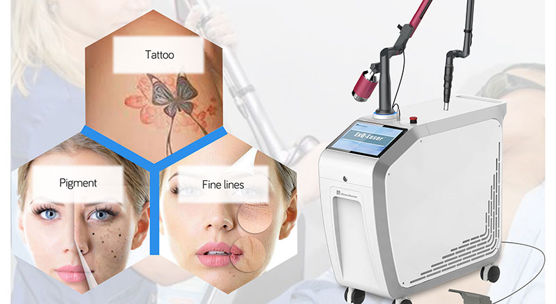 Six Points About Tattoo Removal