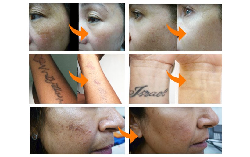 Laser treatment of chloasma is very safe treatment method