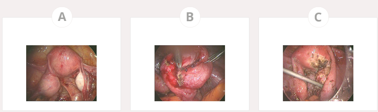 Gynecology Minimally Surgery Laser 1470nm