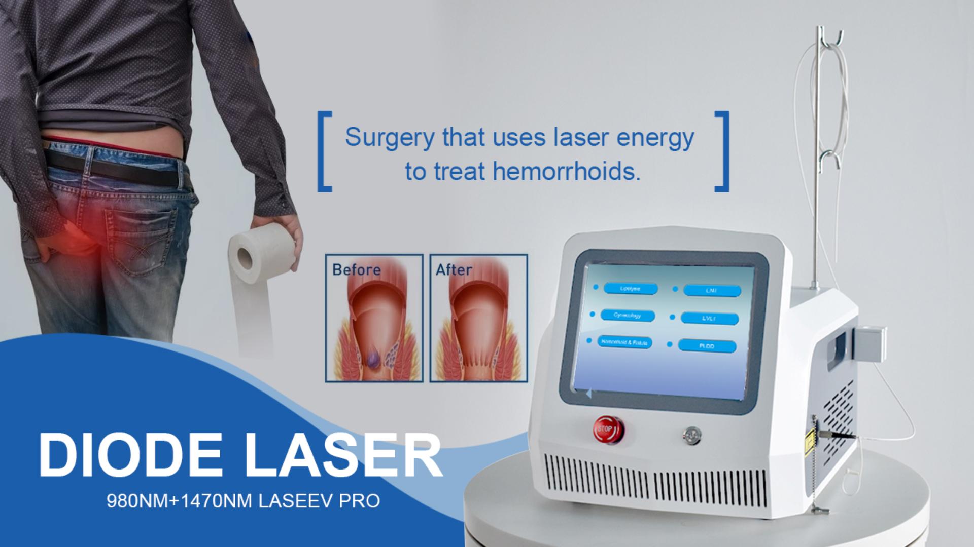 Chii chinonzi Laser Treatment proctology?