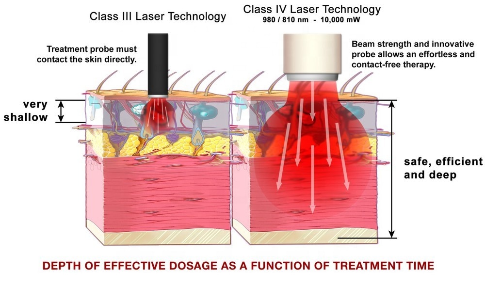 Zer da potentzia handiko ehun sakoneko laser terapia?