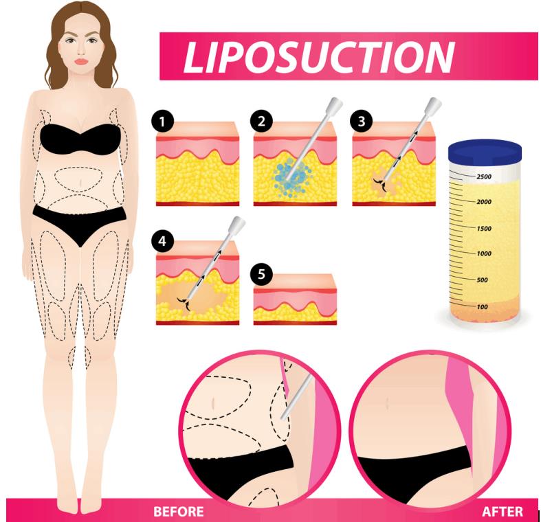 Laser Lipolysis VS Liposuction