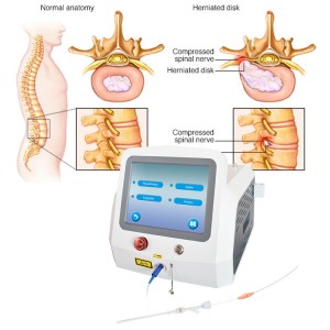 ផលិតផលថ្មី Minimally Invasive Class IV Laser Spinal 980nm 1470nm Pldd for Lumbar Disk Herniation Laser Disc Decompression Physical Therapy Laser