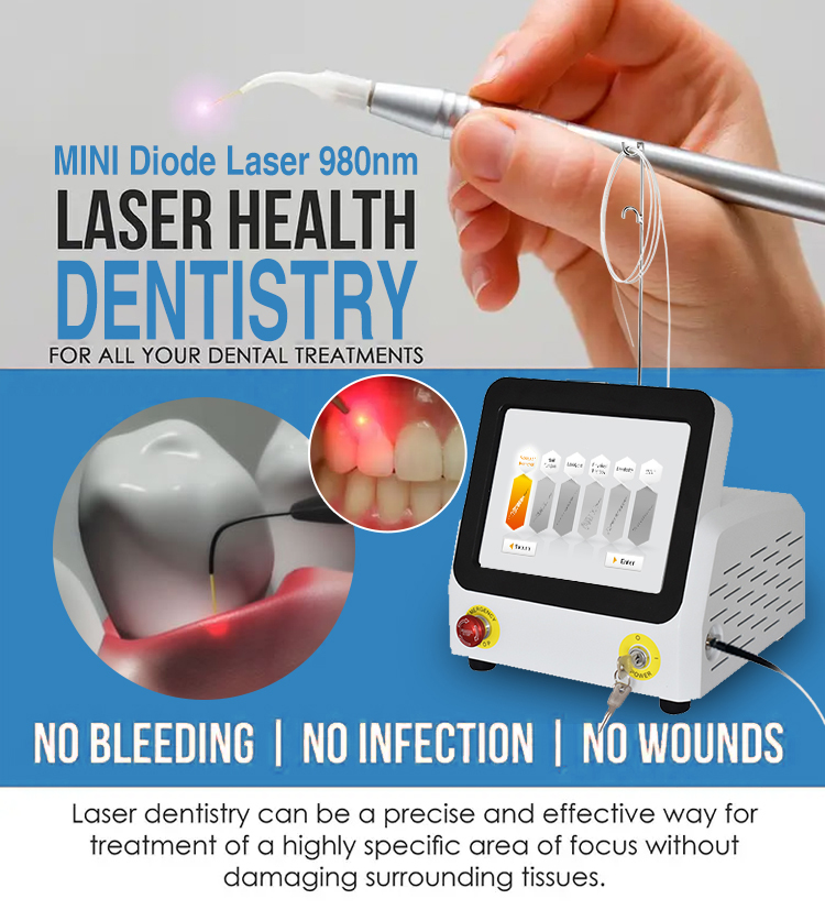 Hoe gaan dit met diode-laserbehandeling vir tandheelkundige?