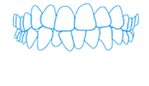Mostra a malocclusione di denti affollati