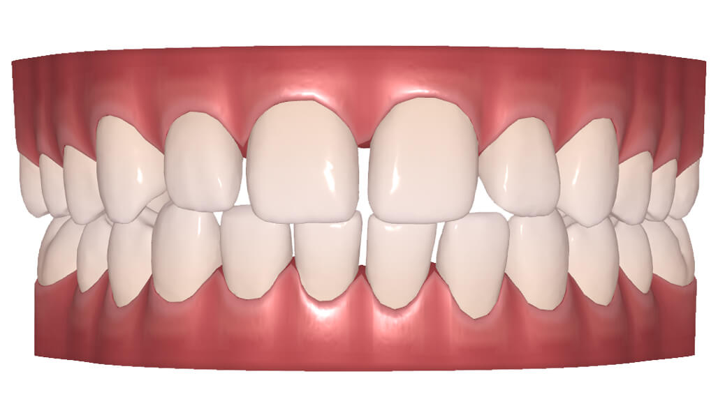 Vis med afstand mellem tænder malocclusion med en kæbe
